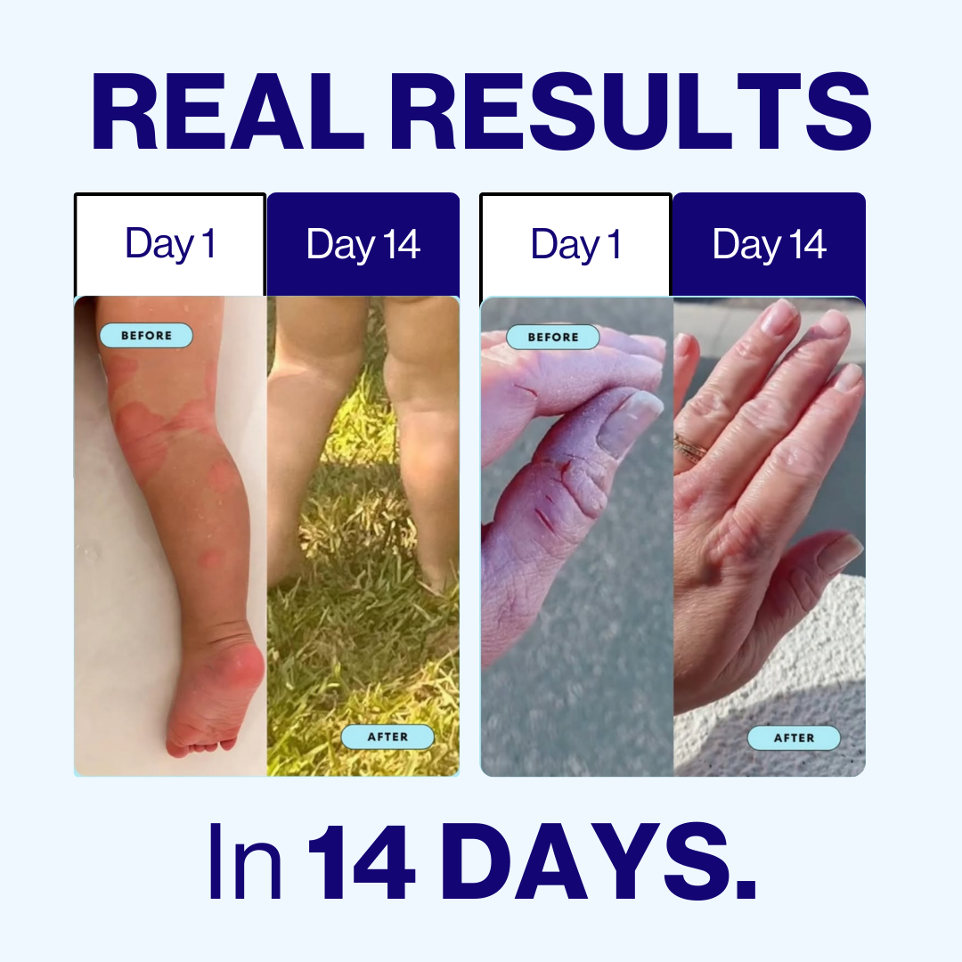 The Sea Cleared My Eczema™ - Soothing Cream