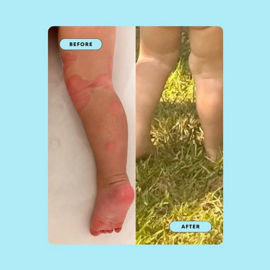The Sea Cleared My Eczema™ daily defence cream for dry, itchy skin – 120g