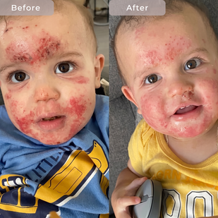His cheeks cleared in 3 weeks