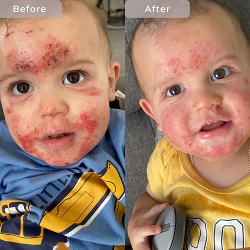 The Sea Cleared My Eczema™ daily defence cream for dry, itchy skin – 120g