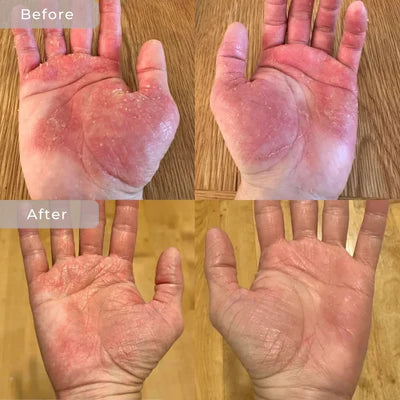 The Sea Cleared My Eczema™ daily defence cream for dry, itchy skin – 120g